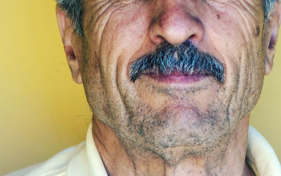 Dermatoporosis: Aging Skin